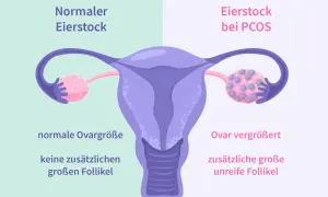 Porównanie jajnika: normalny vs. przy PCOS. Przy PCOS jajnik jest powiększony, z licznymi niedojrzałymi pęcherzykami.
