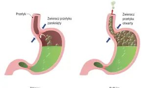 Zdrowy żołądek z zamkniętym zwieraczem przełyku vs. refluks, gdzie otwarty zwieracz pozwala treści żołądkowej cofnąć się do przełyku.