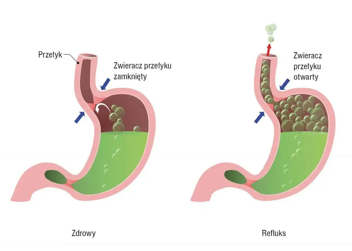 Zdrowy żołądek z zamkniętym zwieraczem przełyku vs. refluks, gdzie otwarty zwieracz pozwala treści żołądkowej cofnąć się do przełyku.