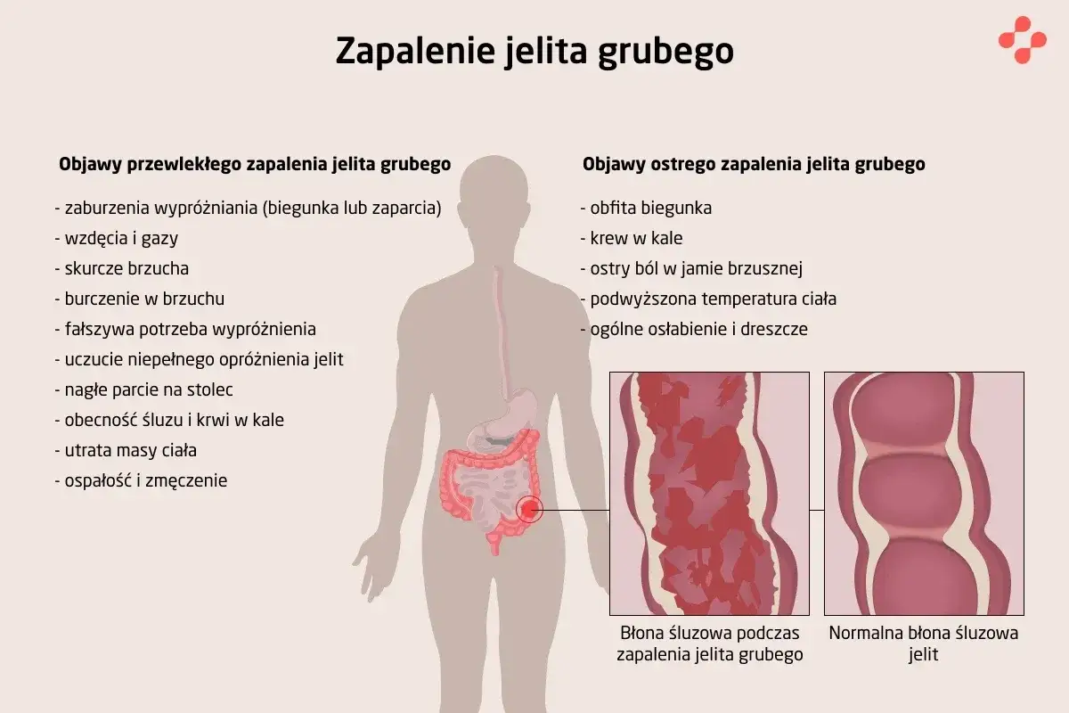 Zapalenie jelit objawy: biegunka, zaparcia, wzdęcia, bóle brzucha, krew w kale, gorączka, osłabienie. Ilustracja porównuje błonę śluzową jelita zdrowego i chorego.
